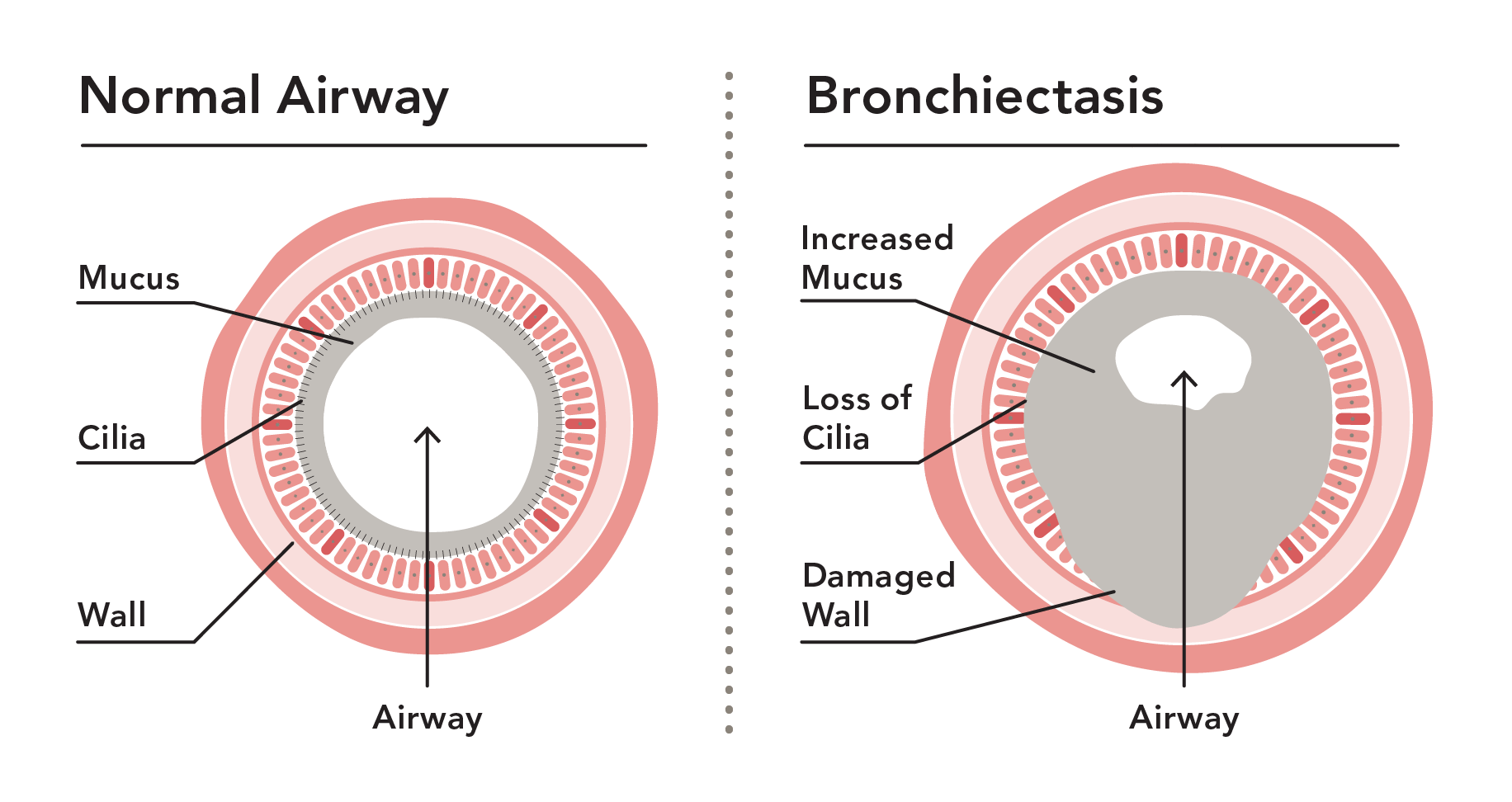 Understanding and Managing Bronchiectasis SmartVest