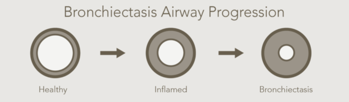 Graphic of airway obstruction with bronchiectasis symptoms.