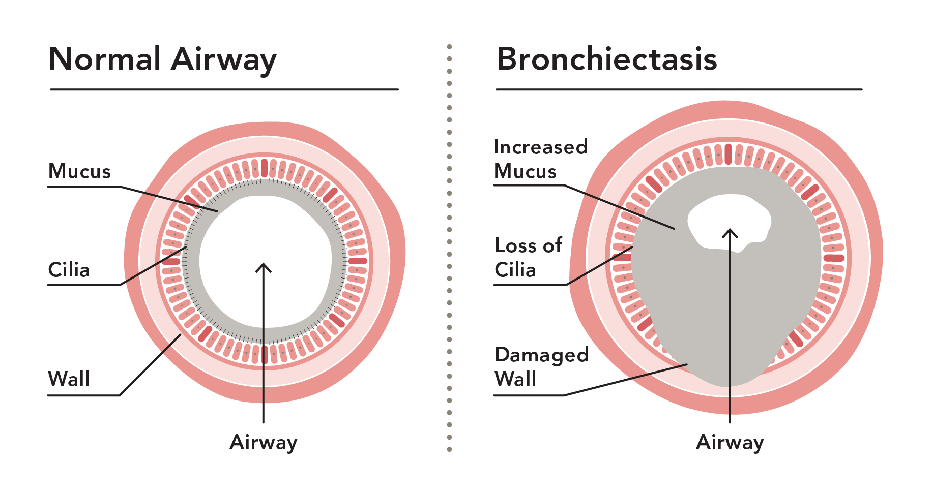 A diagram showing the difference between a normal airway and one with bronchiectasis