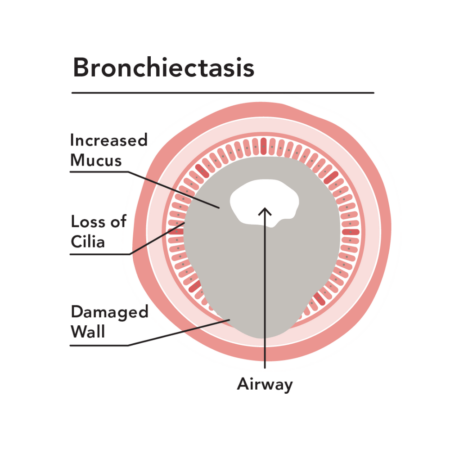 A diagram of an airway that is affected by bronchiectasis