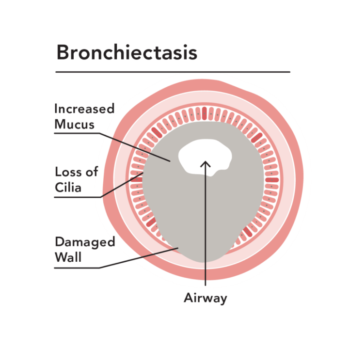 Diagram of an airway with Bronchiectasis before treatment with SmartVest