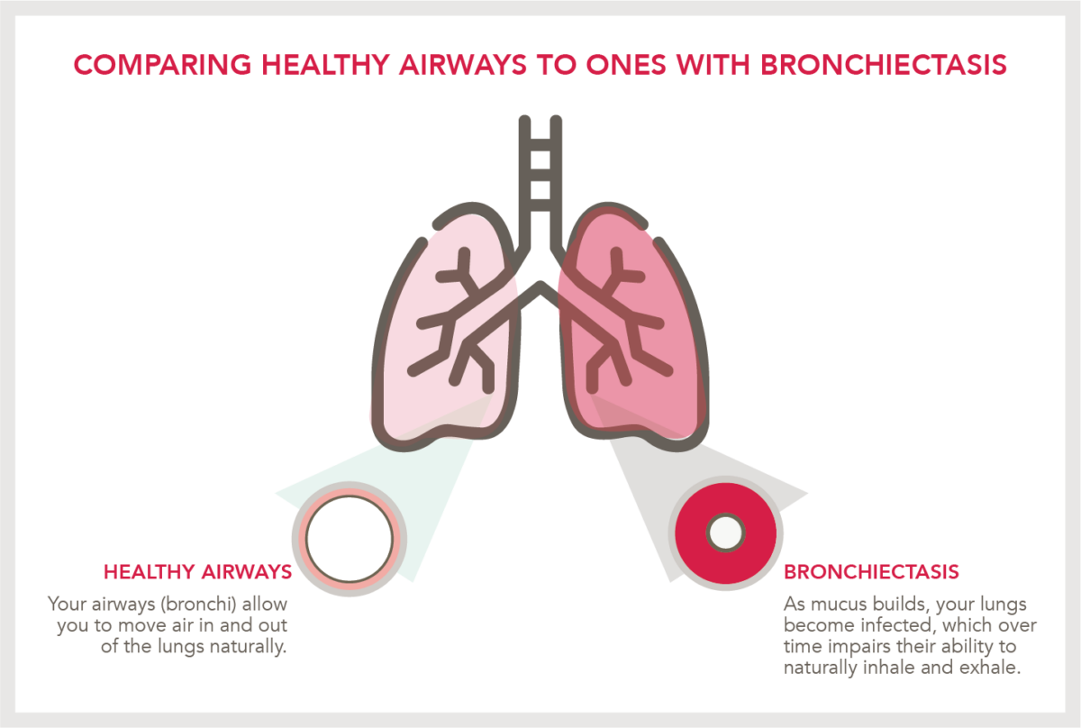 Graphic icon to show comparison of heathy lung and one affected by bronchiectasis symptoms.