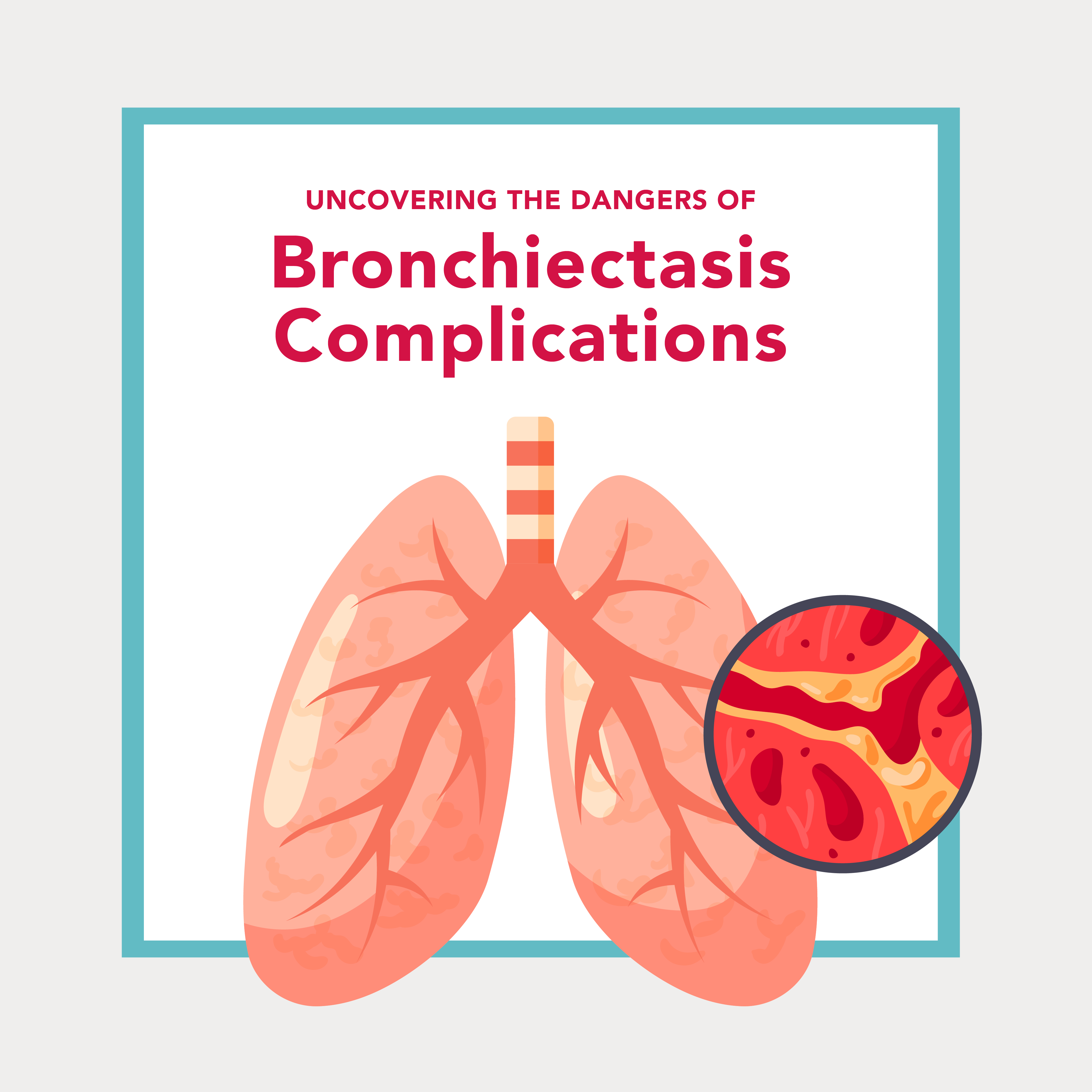 Bronchiectasis Complications: What’s at Risk? | SmartVest