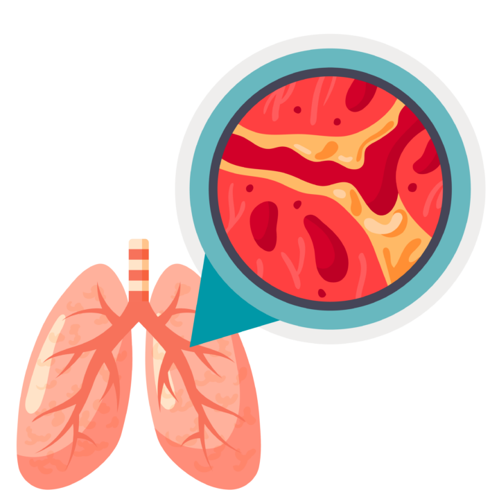 Bronchiectasis Complications: What’s at Risk? | SmartVest