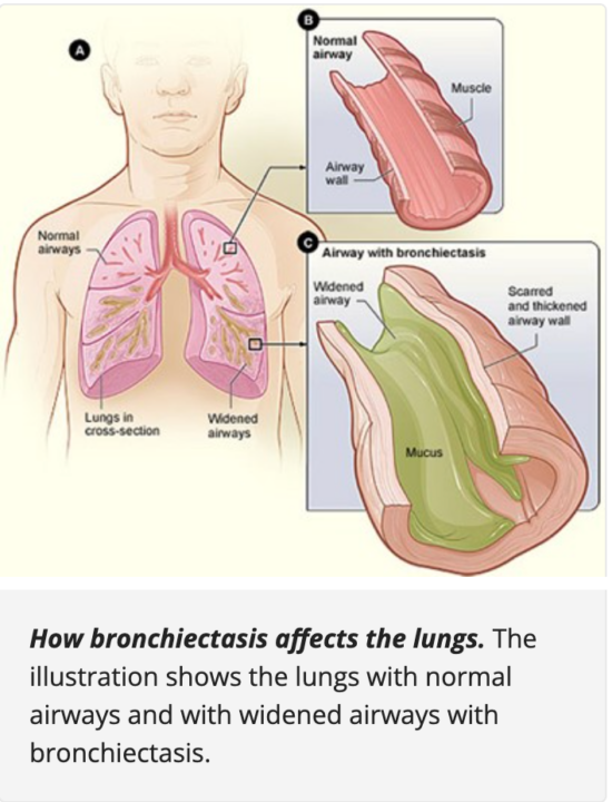 How Bronchiectasis affects the lungs