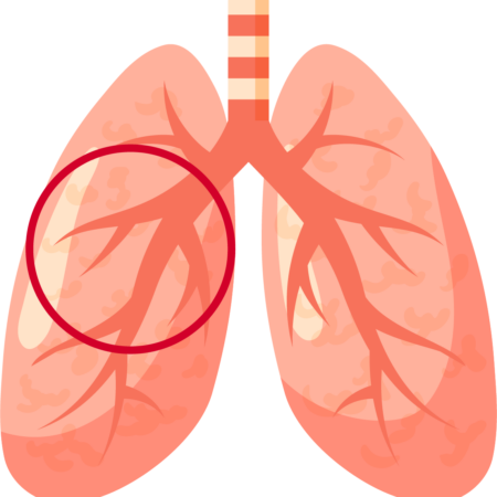 Understanding Bronchiectasis